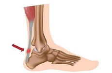 ACHILLES-TENDONITIS-49135.jpg