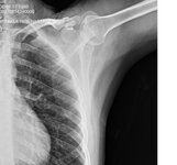 ameliyat sonrası 1.JPG